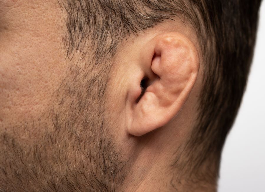 Man has cauliflower ear due to BJJ training 
